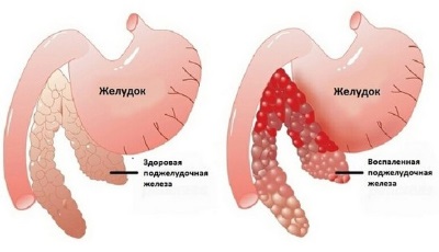 Как лечить воспаление поджелудочной железы в домашних условиях 