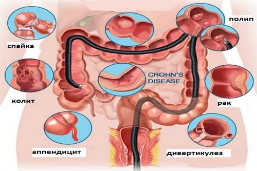 Как проверить кишечник на заболевания? 