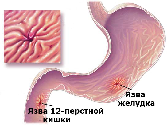 Как вылечить язву двенадцатиперстной кишки в домашних условиях 