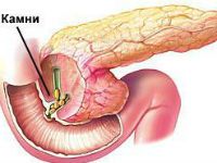 Камни в поджелудочной железе 