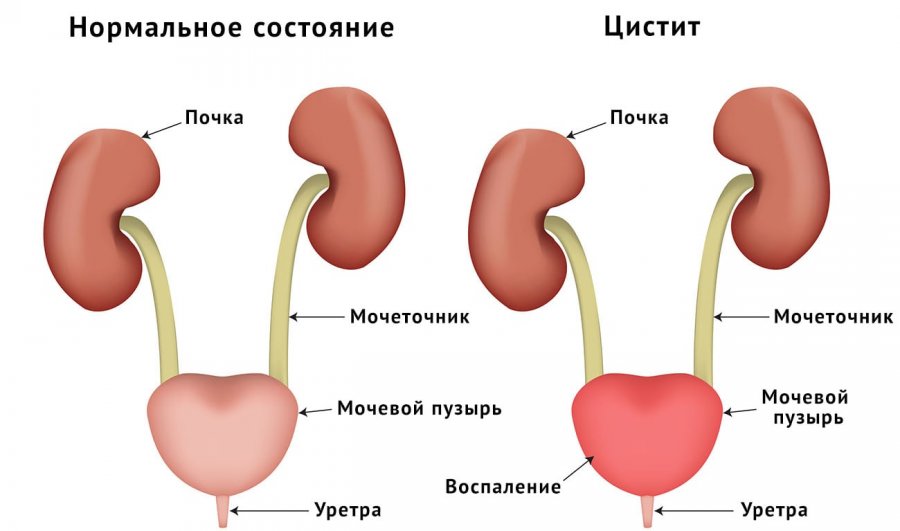 Чем лечить цистит при грудном вскармливании? 