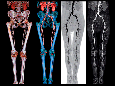 МСКТ нижних конечностей (Ангиография) 