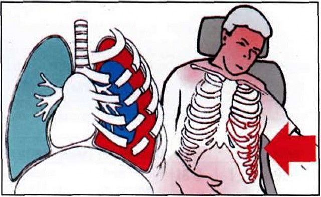 Оказание помощи при ранении грудной клетки 