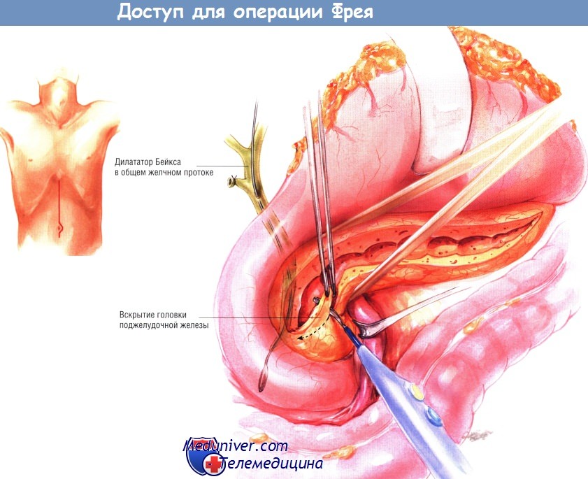 Операция фрея 