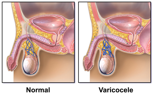 Операция мармара при варикоцеле: техника проведения и осложнения 