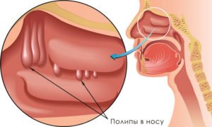 Операция по удалению полипов в носу 