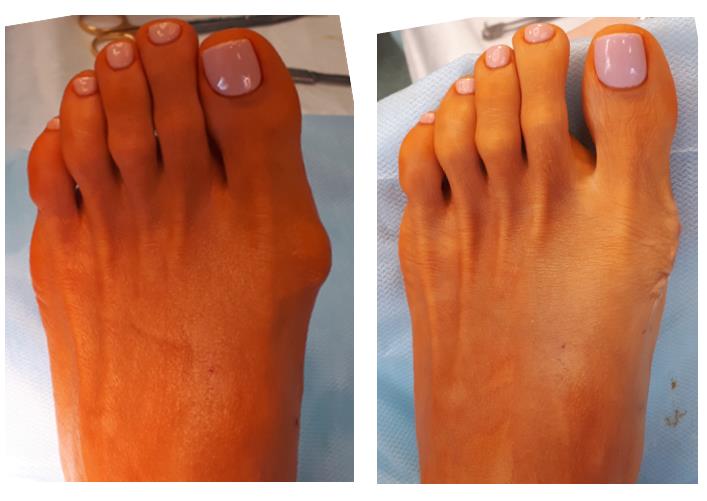 Операция Шеде при Hallux Valgus 