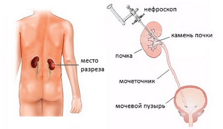 Перкутанная (чрескожная) нефролитотрипсия 