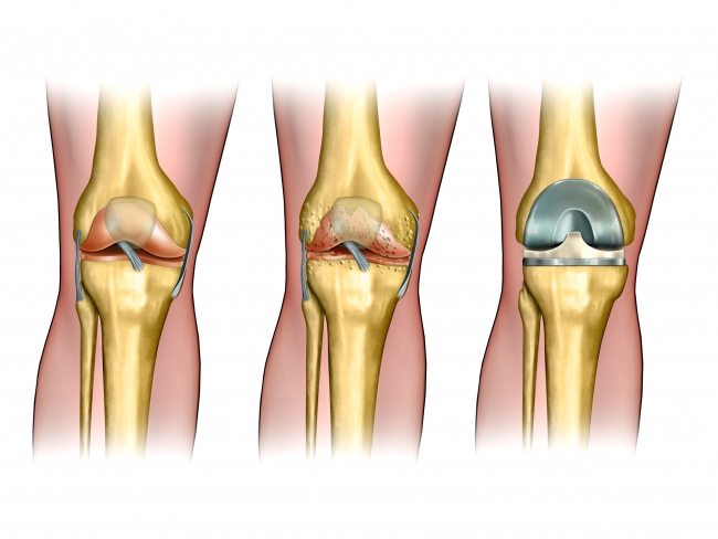 Правильная реабилитация после операции эндопротезирования коленного сустава 