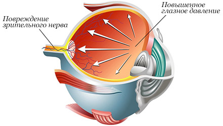 Правильное питание при глаукоме глаз 