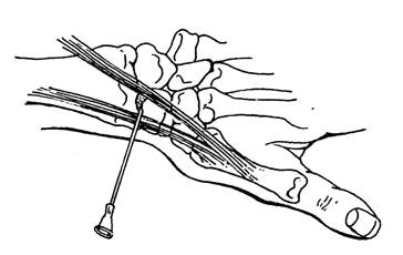 Пункция лучезапястного сустава техника 