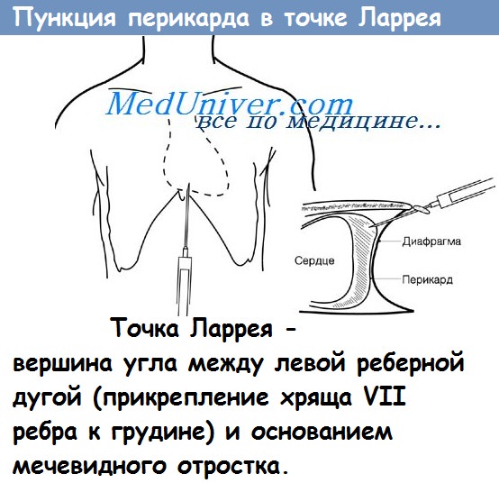 Пункция перикарда по Марфану 