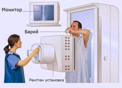 Рентгеноскопия желудка 