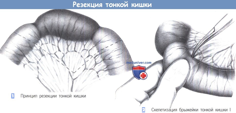 Резекция кишечника, операция по удалению кишки: показания, ход, реабилитация 