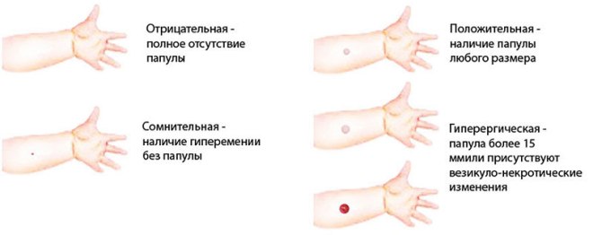 Что делать, если у ребенка большая и красная Манту: почему бывает плохая реакция и гиперемия? 