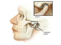 Симптомы и лечение артроза челюстного сустава 