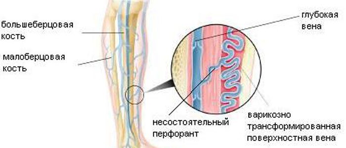 Симптомы и лечение заболевания перфорантных вен нижних конечностей 