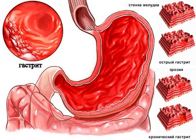 Симптомы и признаки хронического гастрита 
