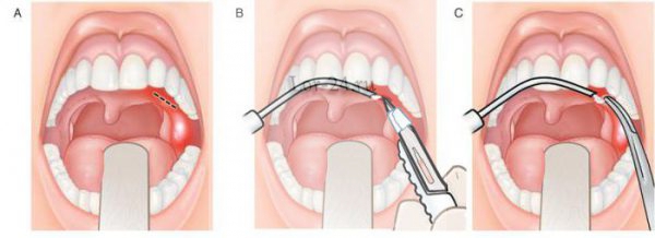 Симптомы, механизм развития и препараты для лечения паратонзиллярного абсцесса 