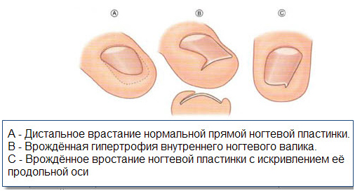 Способы удаления жировика (липомы и атеромы) 