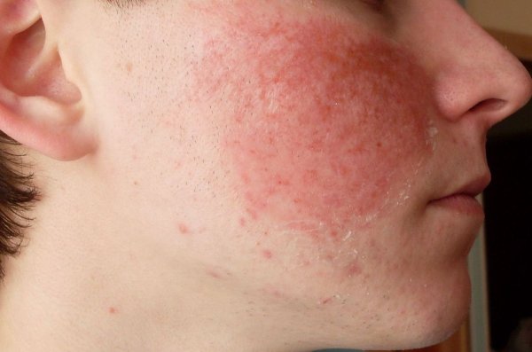 Аллергия на лице — разновидности и методы лечения 