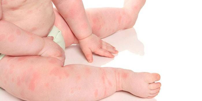Аллергия у новорожденных — первые проявления, выявление аллергенов, лечение и профилактика 