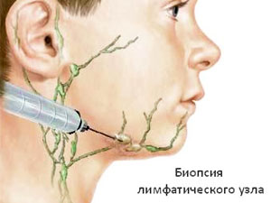 Анализ крови при увеличенных лимфатических узлах 