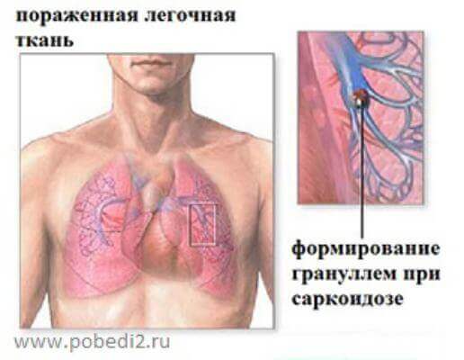 Аутоиммунные заболевания: Саркоидоз 