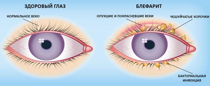 Блефарит — как его лечить у взрослых и малышей? 