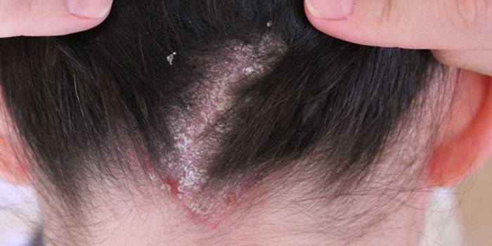 Чем лечить себорейный дерматит на голове 