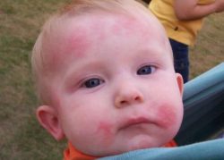 Что делать при аллергии на молоко у ребенка 