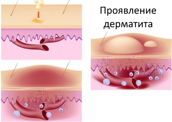 Какие виды спреев применяют для лечения дерматитов 