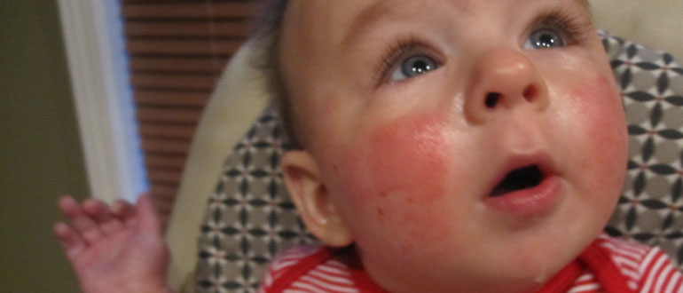 Контактная аллергия у детей фото 