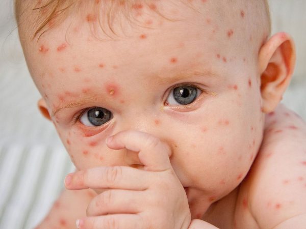 Красные пятна у ребенка на теле — аллергия или что-то еще? 