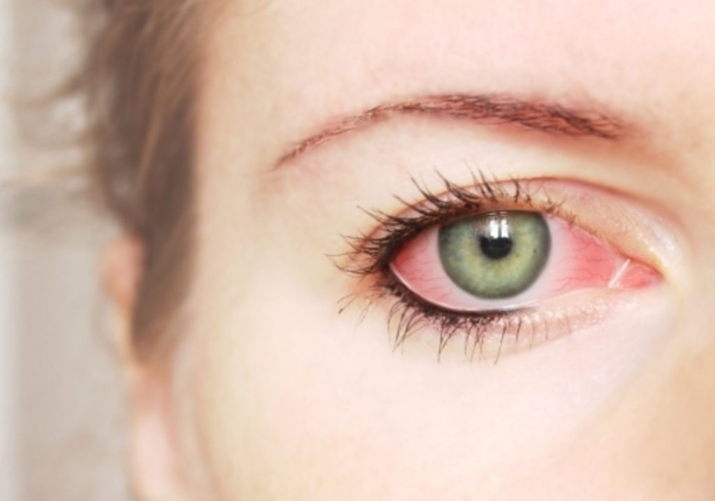 Основные причины покраснения глаз при простуде 