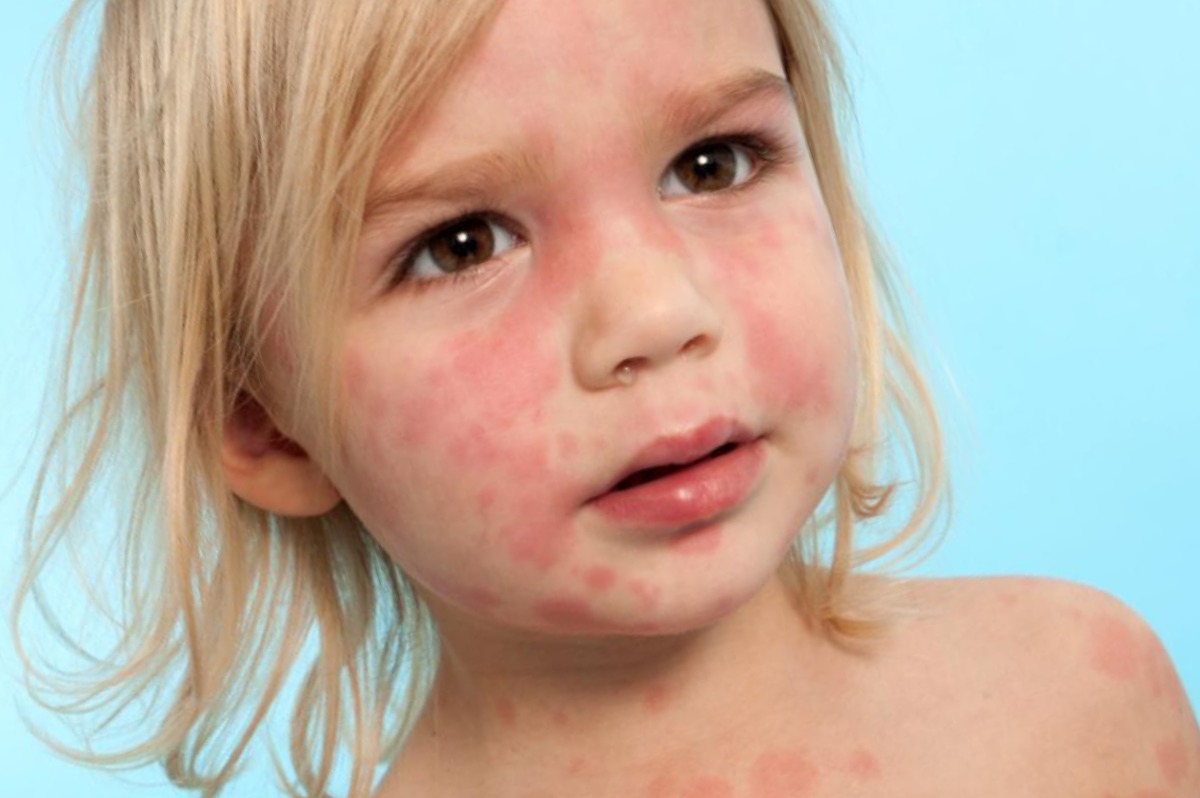 Пищевая аллергия у детей: симптомы и лечение 