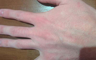 Высыпания на коже при аллергии: фото, причины и симптоматика 