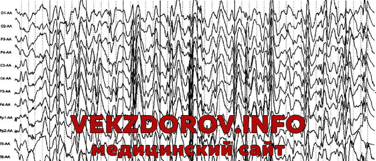 Что такое энцефалограмма головного мозга, и для чего она делается 