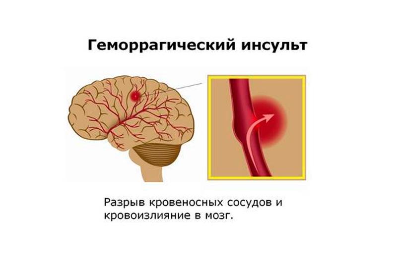 Геморрагический инсульт головного мозга: виды, симптомы, диагностика, лечение, факторы риска 