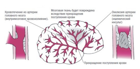 Гирудотерапия при инсульте 