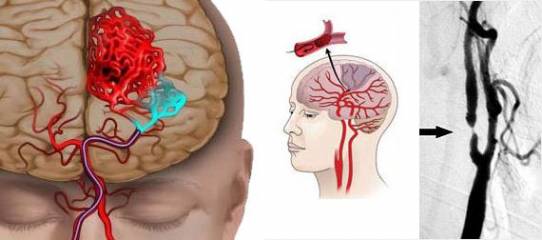 Ишемия головного мозга: симптомы и лечение 