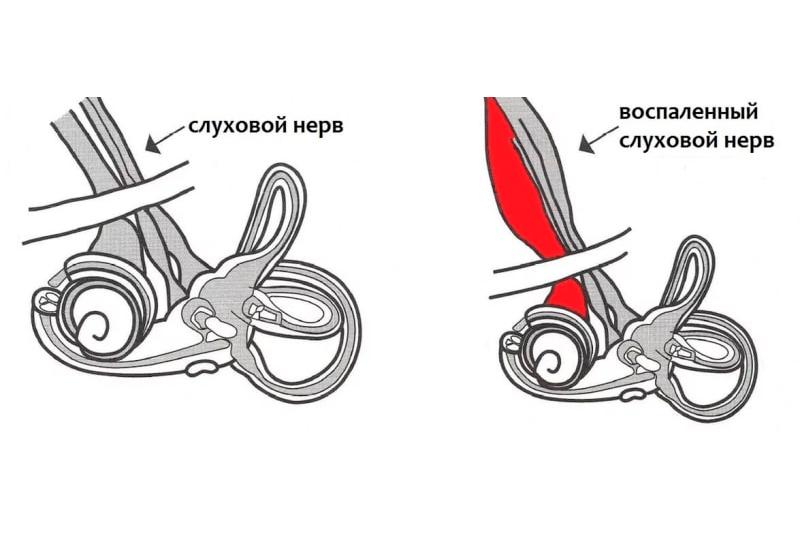 Кохлеарный неврит: причины, симптомы и лечение 