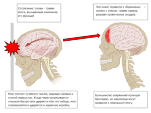 Легкое сотрясение мозга лечение в домашних условиях 