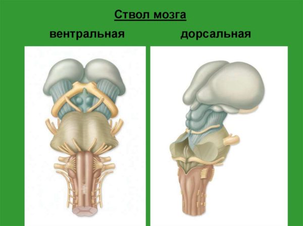 Опухоли ствола мозга 