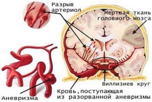 Основные отличия ишемического инсульта от геморрагического 