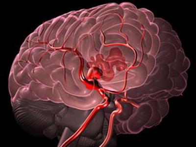 Почему возникает и чем опасно кровоизлияние в мозг 