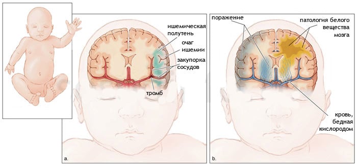 Причины детского инсульта: симптомы, признаки и последствия для головного мозга 