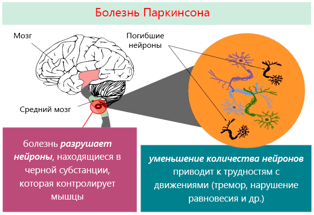 Природа и причины развития болезни Паркинсона 