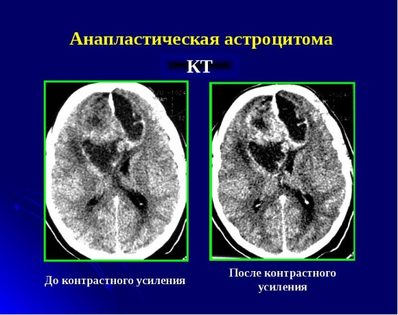 Прогноз для жизни при астроцитомах головного мозга 