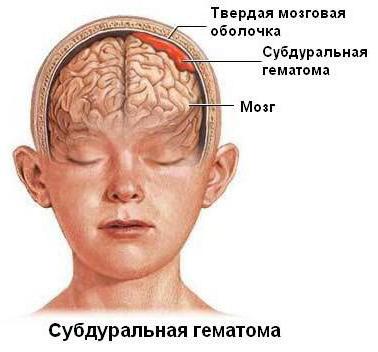 Разновидности и причины субдypaльных гематом 